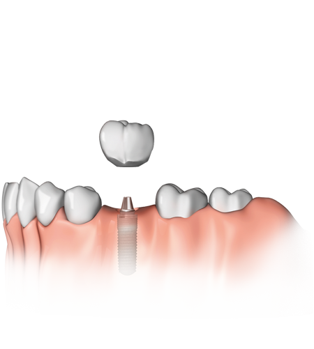 Implantologie : Ein Zahn fehlt  Ein Implantat hat gegenüber einer Brücke den Vorteil, dass Nachbarzähne nicht beschliffen werden müssen.