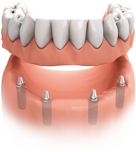 Sehr viele oder alle Zähne fehlen  Mit mehreren Implantaten haben Teil- oder Vollprothesen, herausnehmbar oder festsitzend, einen festen Halt.
